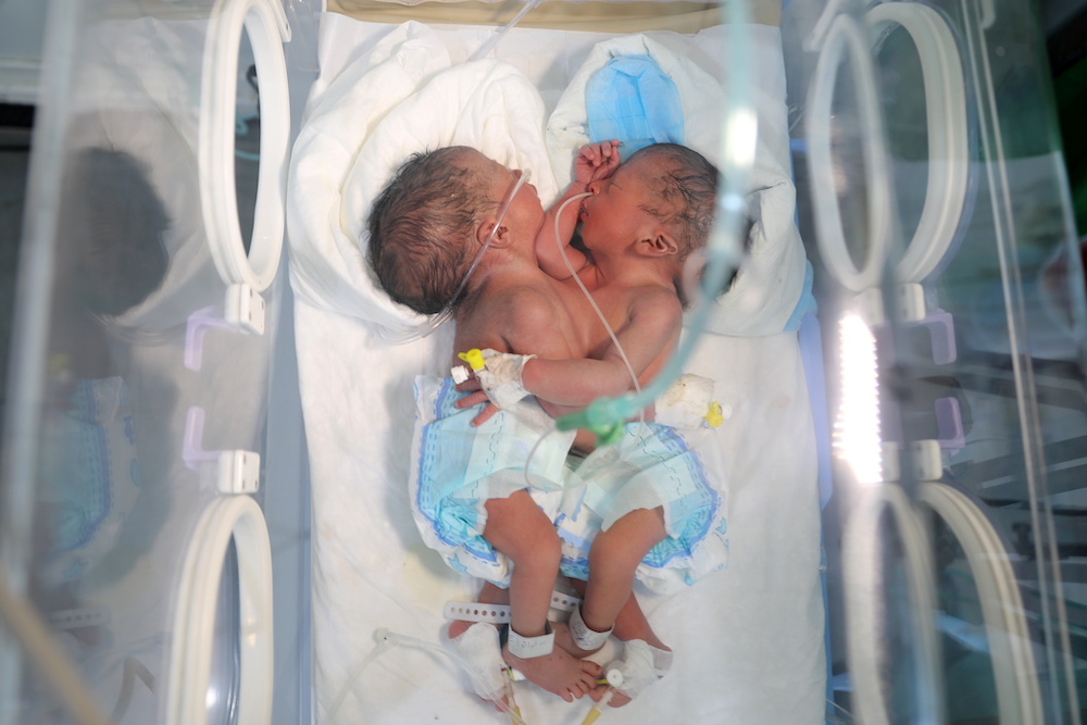 Newly born conjoined twins lie in an incubator at the child intensive care unit of Al-Sabeen hospital in Sanaa, Yemen Dec. 18, 2020. (Reuters) Newly born conjoined twins lie in an incubator at the child intensive care unit of Al-Sabeen hospital in Sanaa, Yemen Dec. 18, 2020. (Reuters)