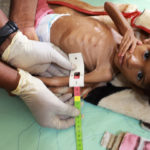 A 5-year-old girl suffering from acute malnutrition is shown undergoing treatment in Yemen's northern Hajjah province in June. (Essa Ahmed/AFP via Getty Images)